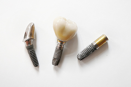 Zahnarzt Burkau Heßke Implantologie